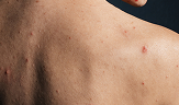 back skin of young girl with pimples acne problems