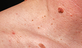 big birthmark on man’s neck