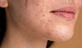 confident young woman with acne close-up
