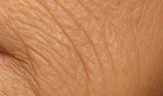 crepey texture