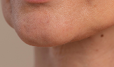 early jowls