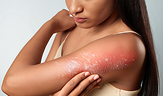 eczema on a lady’s body