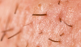 folliculitis