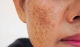hyperpigmentation and melasma
