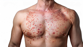 man’s chest with skin condition - red spots