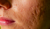 post acne scars, red festering pimples, on a young woman’s face