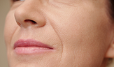 woman with nasolabial folds