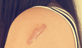woman with scar on her arm